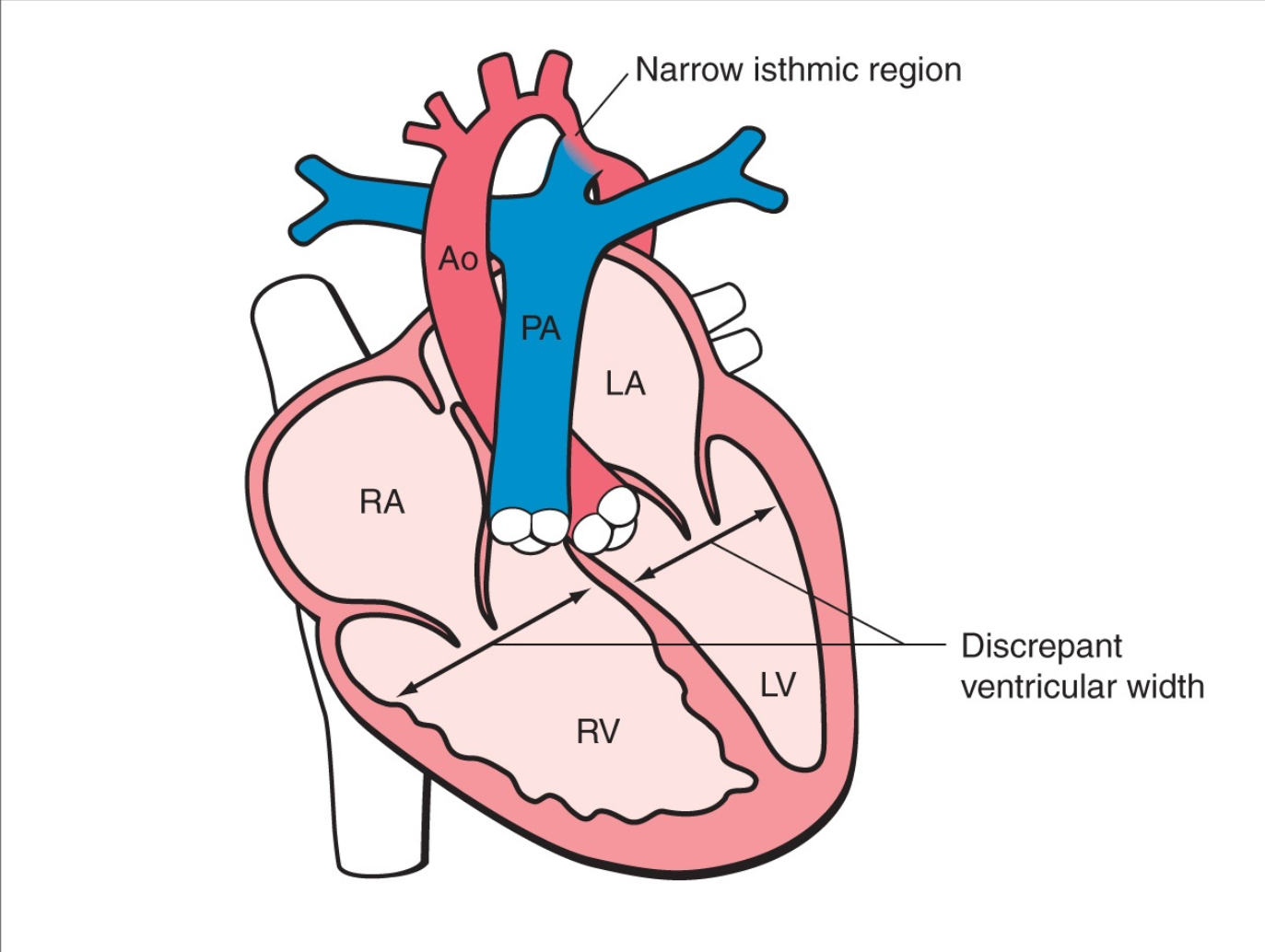 HẸp Eo ĐỘng MẠch ChỦ (coarctation Of The Aorta)