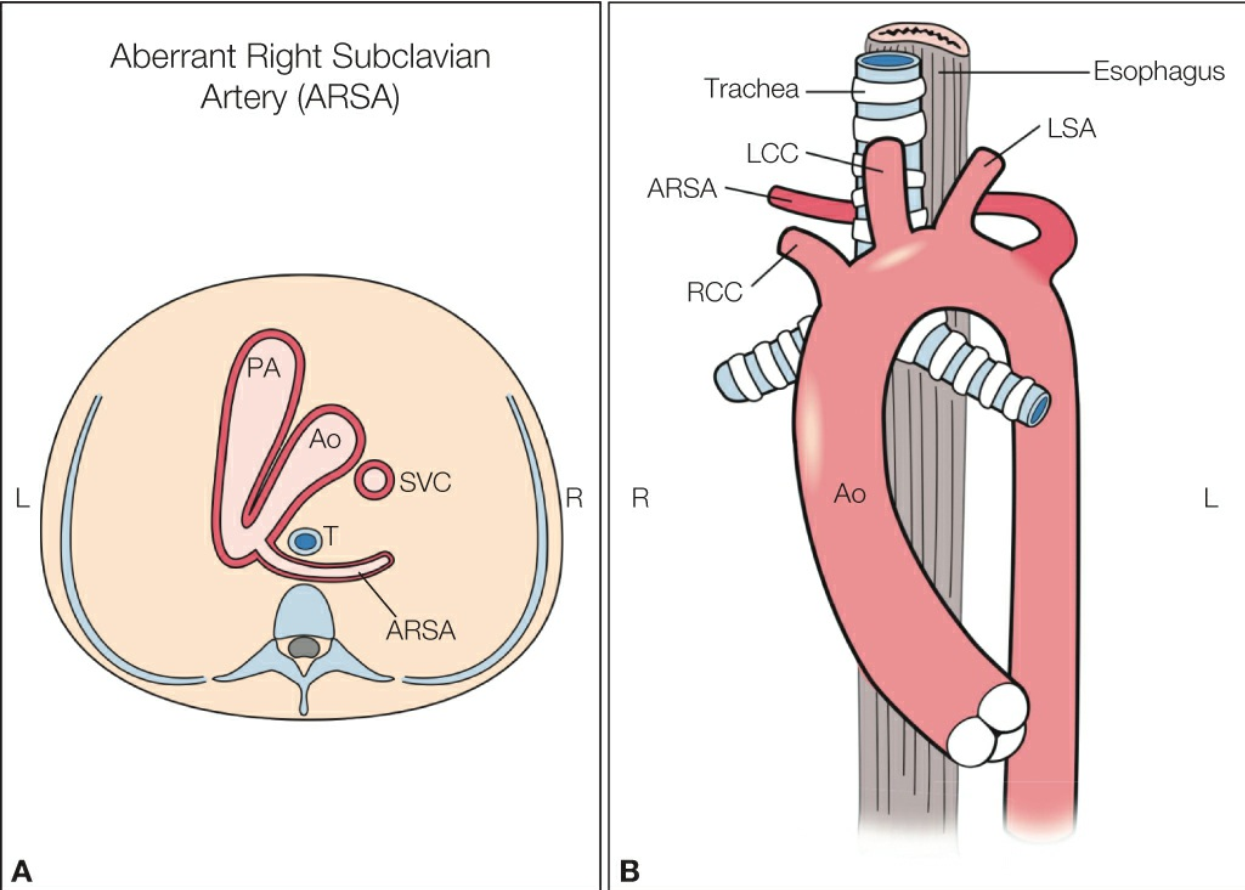 GIÁN ĐOẠN QUAI ĐỘNG MẠCH CHỦ (INTERRUPTION OF THE AORTIC ARCH)