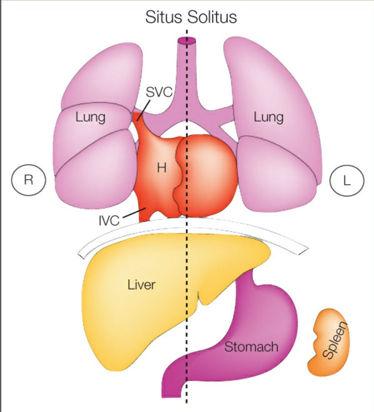 HỘI CHỨNG ĐỒNG DẠNG (HETEROTAXY SYNDROME)