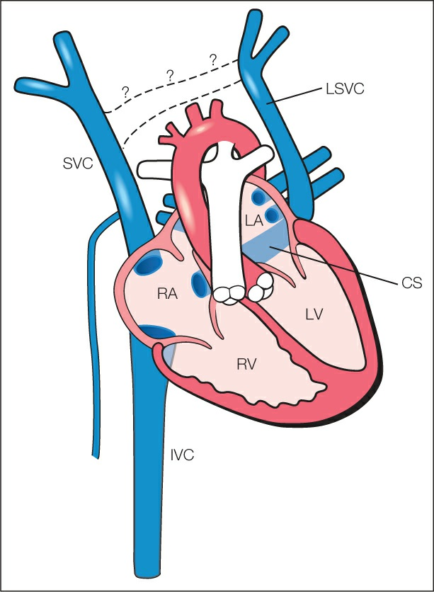 TỒN TẠI TĨNH MẠCH CHỦ TRÊN BÊN TRÁI (Persistent left superior vena cava)