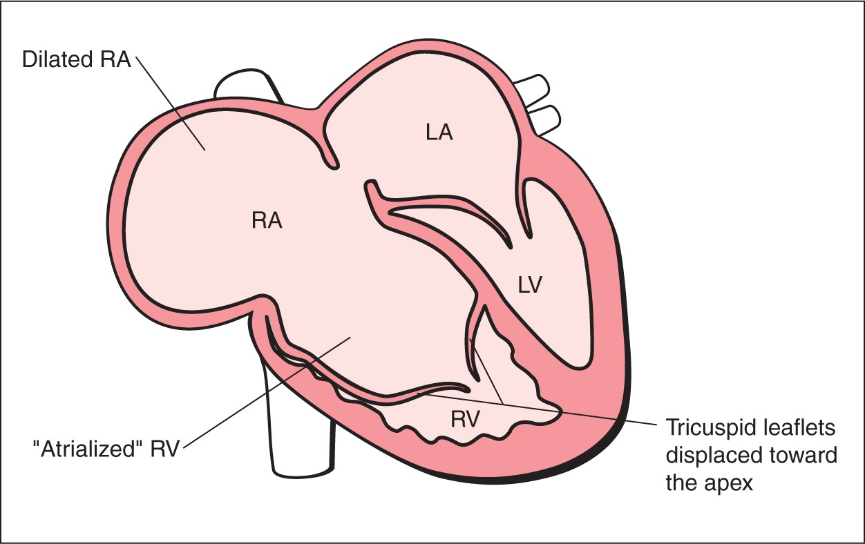 Bất thường thất phải