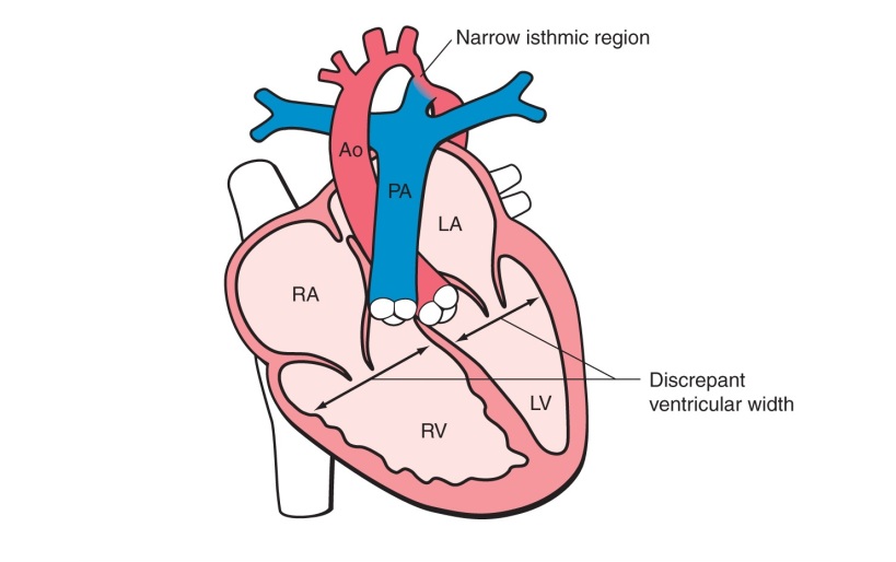 HẸP EO ĐỘNG MẠCH CHỦ (COARCTATION OF THE AORTA)