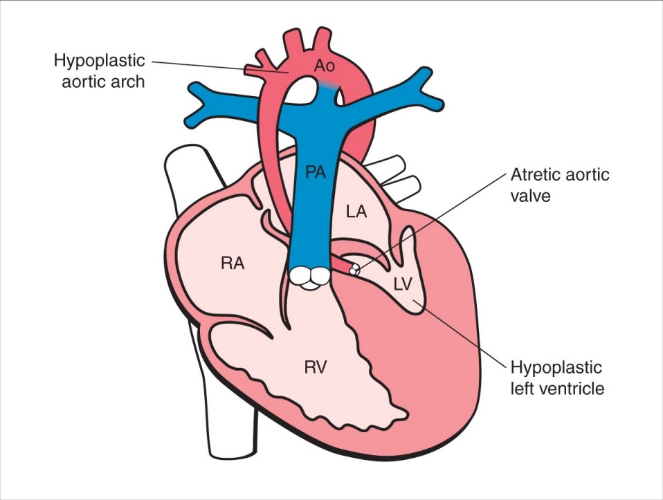 HỘI CHỨNG THIỂU SẢN THẤT TRÁI  (HYPOPLASTIC LEFT HEART SYNDROME)